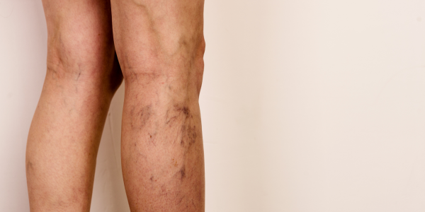 Qu'est-ce que la chirurgie pour traiter la maladie veineuse ?