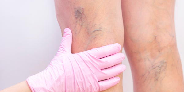 Qu'est-ce qu'une sclérose ?